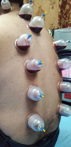 Hijama (Home visits Available)